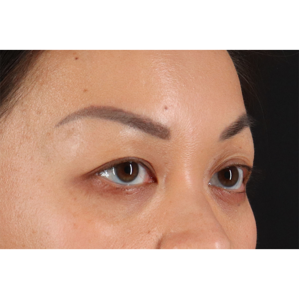 Eyelid Surgery Before & After Patient #2883
