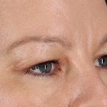 Eyelid Surgery Before & After Patient #2885