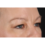 Eyelid Surgery Before & After Patient #2885