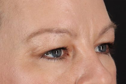 Eyelid Surgery Before & After Patient #2885