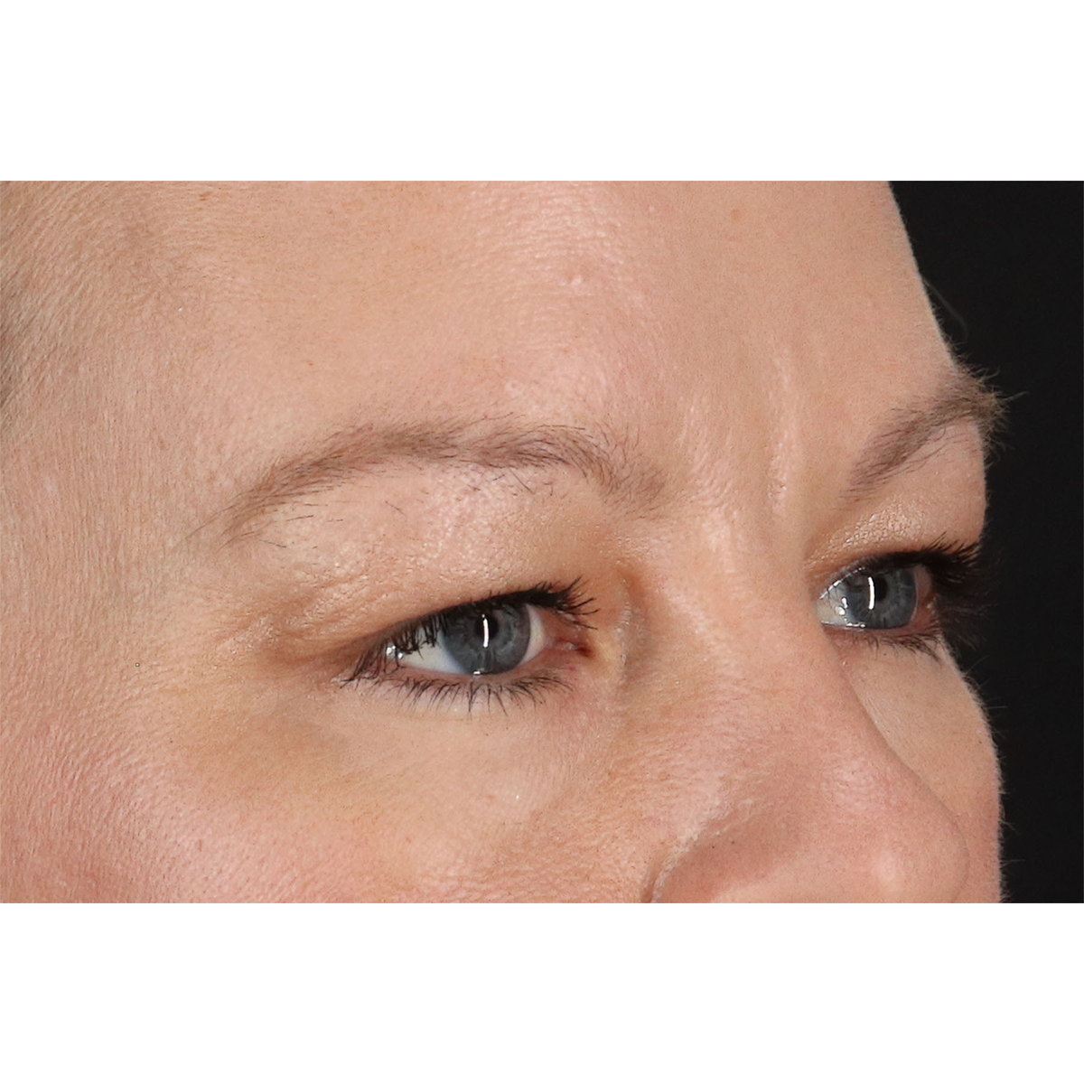 Eyelid Surgery Before & After Patient #2885