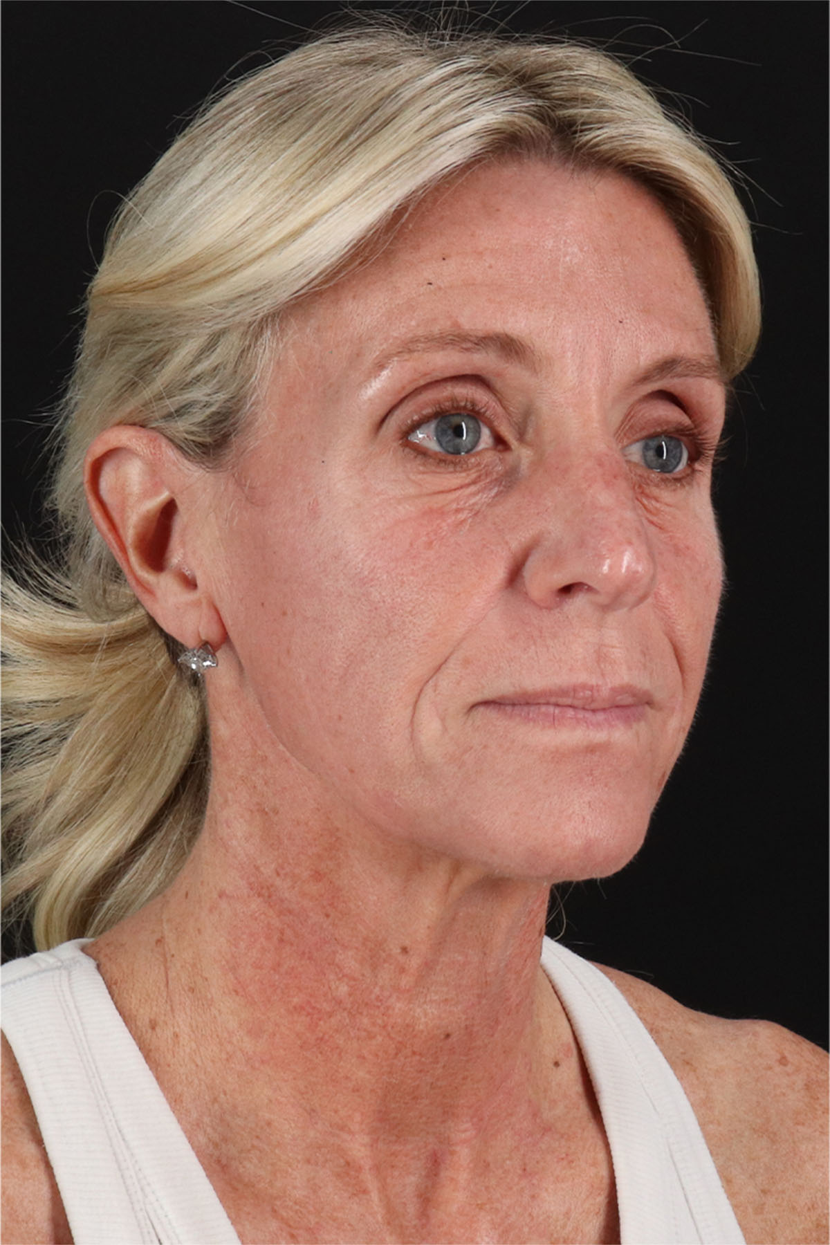 Structural Fat Grafting Before & After Patient #3650