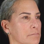 CO2 Laser Before & After Patient #2878