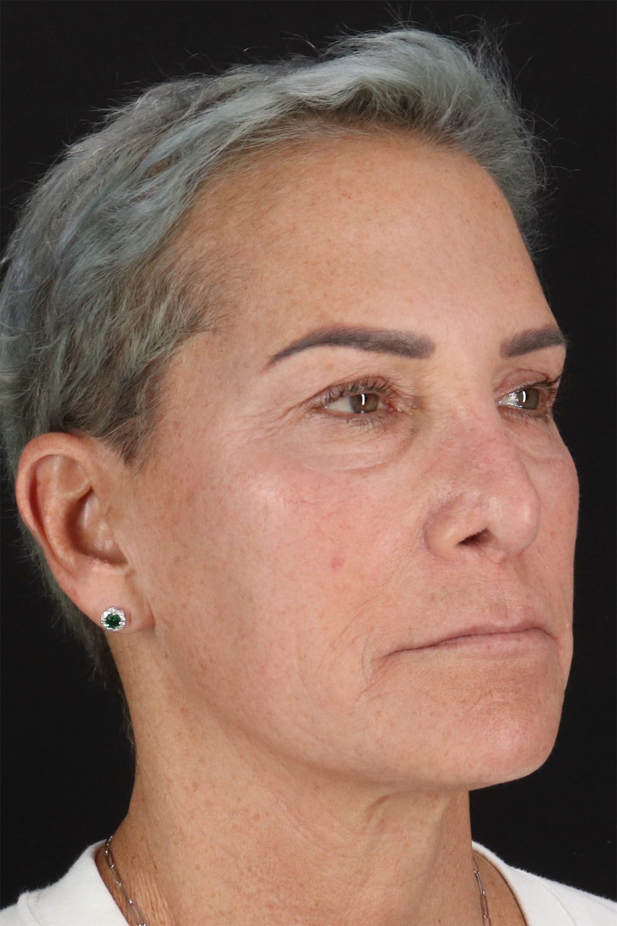 CO2 Laser Before & After Patient #2878