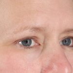 Eyelid Surgery Before & After Patient #2879