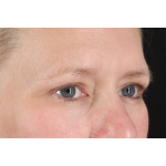 Eyelid Surgery Before & After Patient #2879