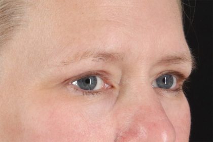Eyelid Surgery Before & After Patient #2879