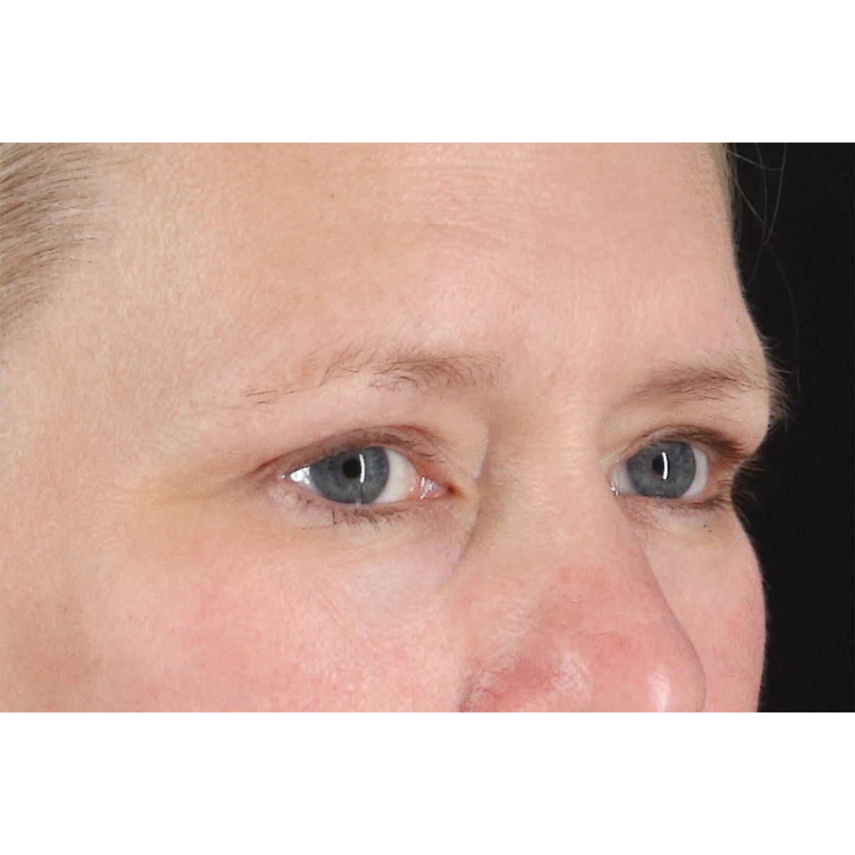 Eyelid Surgery Before & After Patient #2879