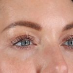 Eyelid Surgery Before & After Patient #2882