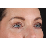 Eyelid Surgery Before & After Patient #2882