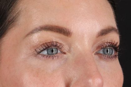 Eyelid Surgery Before & After Patient #2882