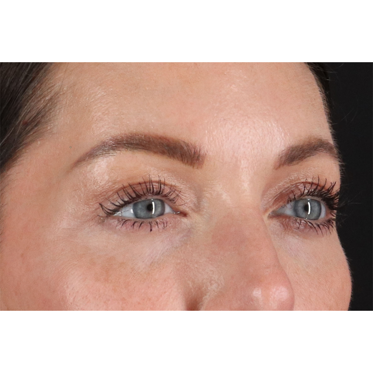 Eyelid Surgery Before & After Patient #2882