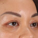 Eyelid Surgery Before & After Patient #2883
