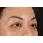 Eyelid Surgery Before & After Patient #2883
