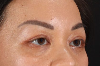 Eyelid Surgery Before & After Patient #2883