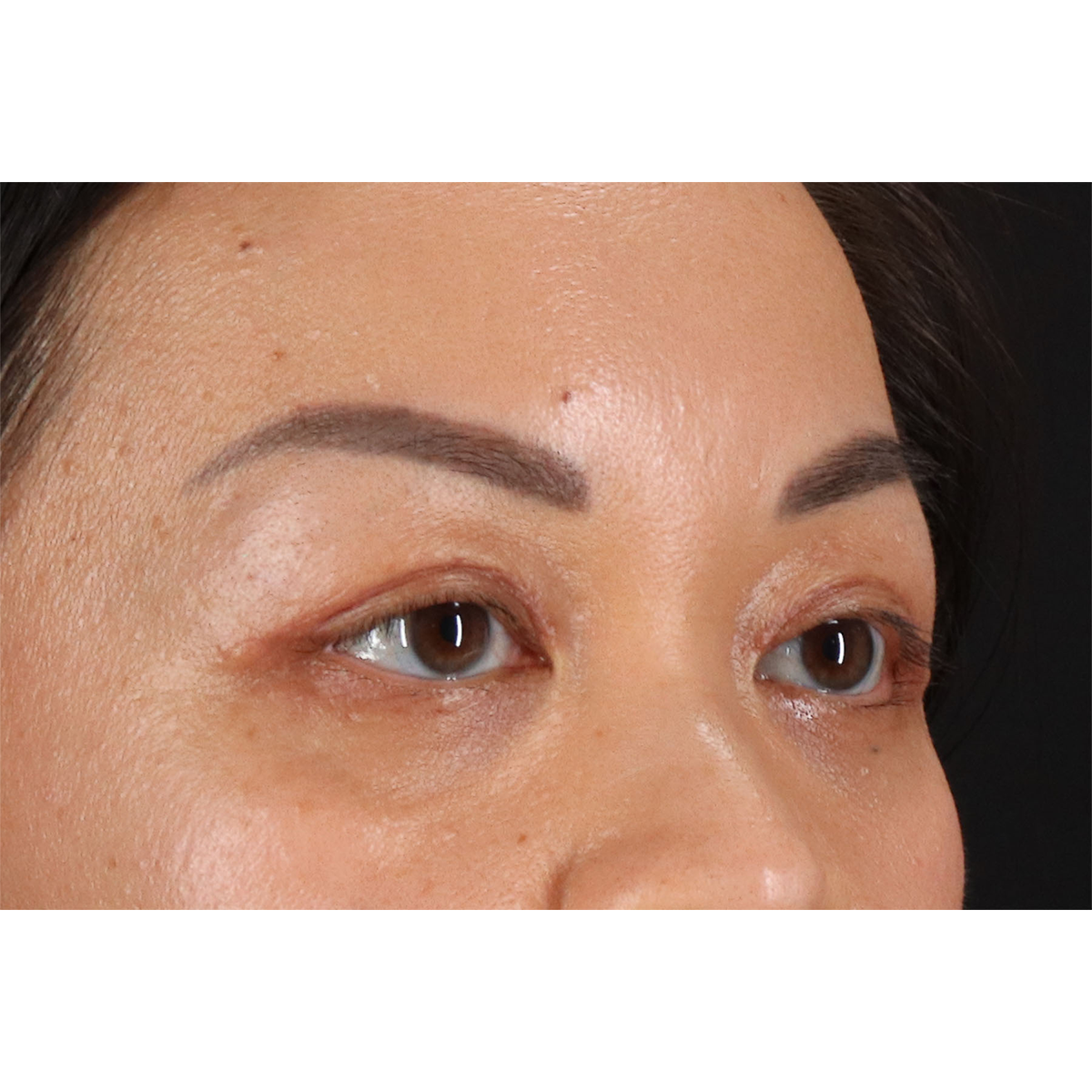 Eyelid Surgery Before & After Patient #2883