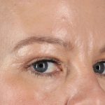 Eyelid Surgery Before & After Patient #2885