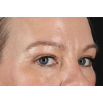Eyelid Surgery Before & After Patient #2885