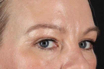 Eyelid Surgery Before & After Patient #2885