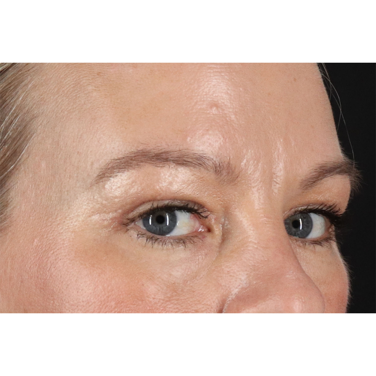 Eyelid Surgery Before & After Patient #2885