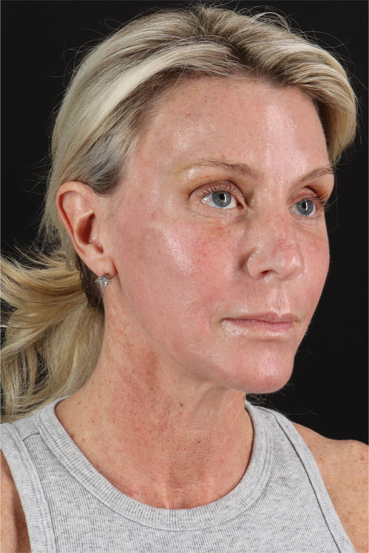 Structural Fat Grafting Before & After Patient #3650