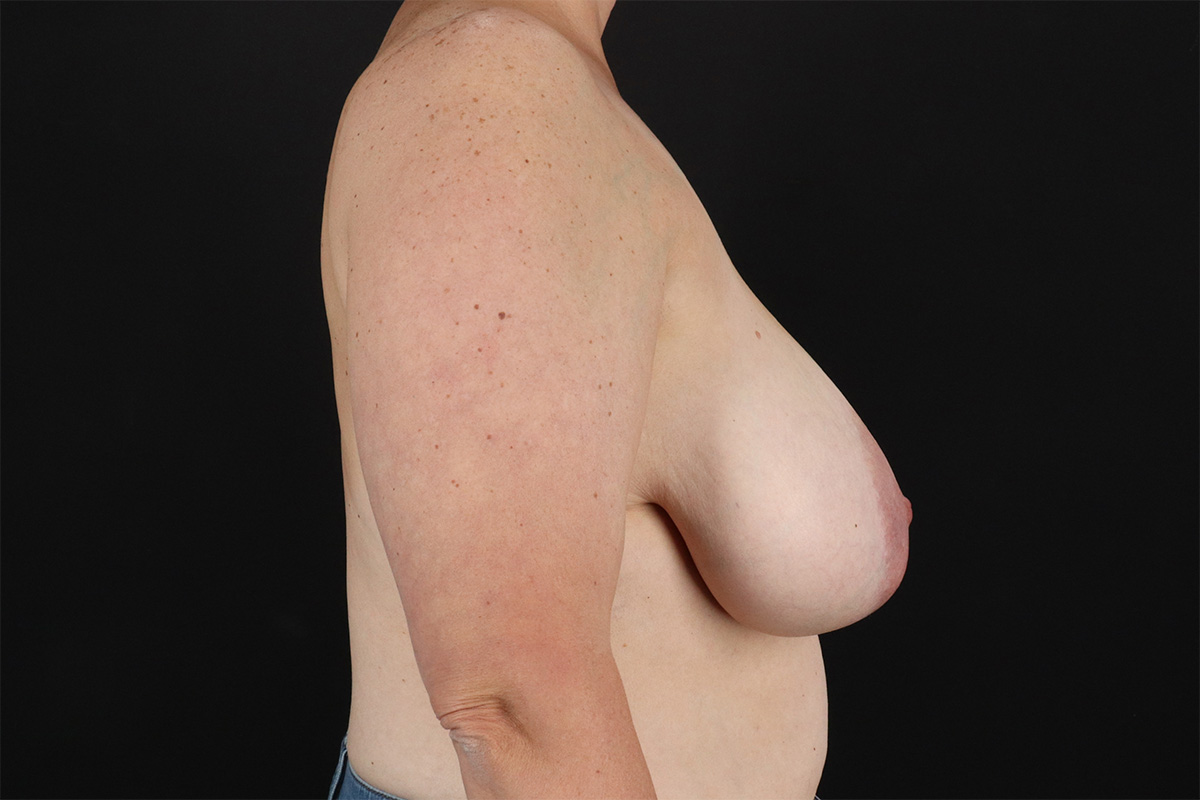 Breast Reduction with Lift Before & After Patient #2877
