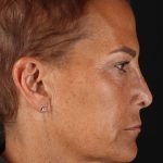 CO2 Laser Before & After Patient #2878