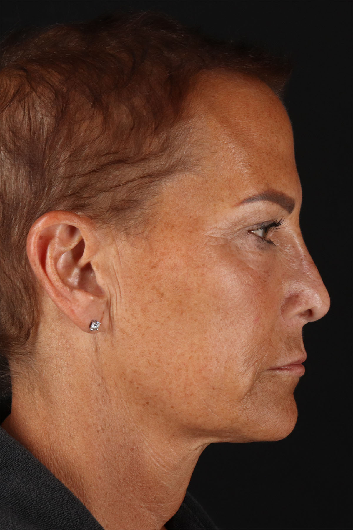 CO2 Laser Before & After Patient #2878
