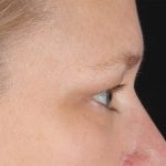 Eyelid Surgery Before & After Patient #2879