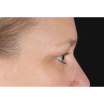 Eyelid Surgery Before & After Patient #2879