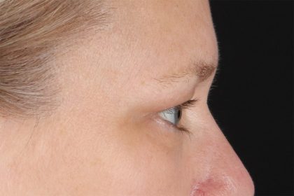 Eyelid Surgery Before & After Patient #2879