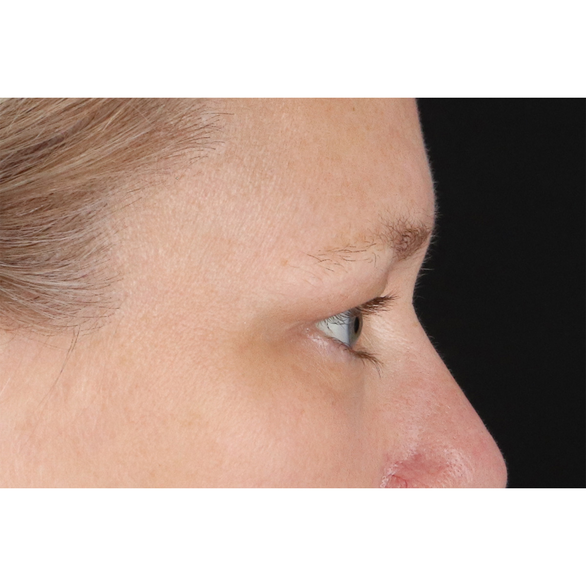 Eyelid Surgery Before & After Patient #2879