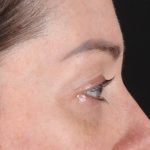 Eyelid Surgery Before & After Patient #2882