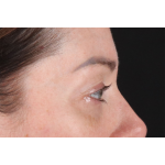 Eyelid Surgery Before & After Patient #2882