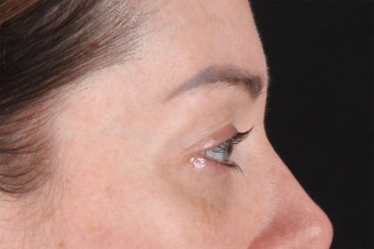 Eyelid Surgery Before & After Patient #2882