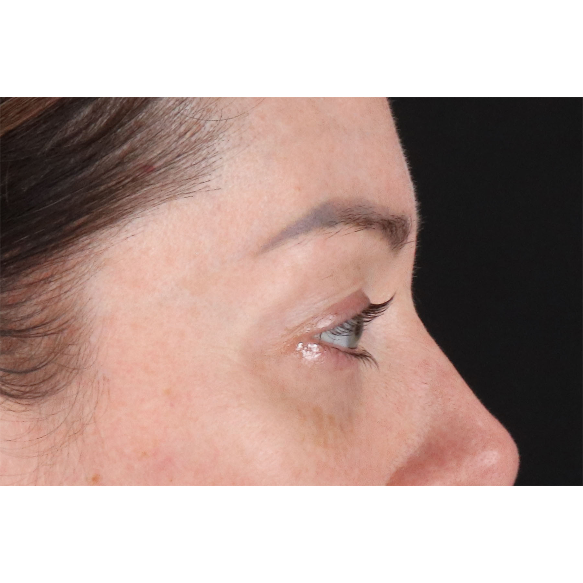 Eyelid Surgery Before & After Patient #2882