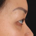 Eyelid Surgery Before & After Patient #2883