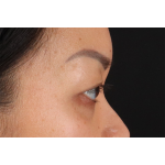 Eyelid Surgery Before & After Patient #2883