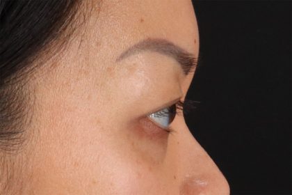 Eyelid Surgery Before & After Patient #2883