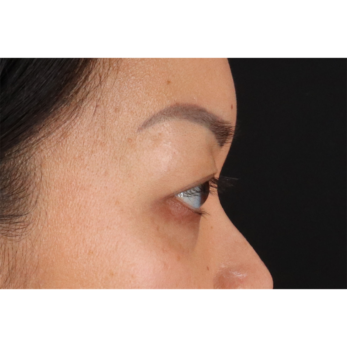 Eyelid Surgery Before & After Patient #2883
