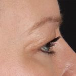 Eyelid Surgery Before & After Patient #2885
