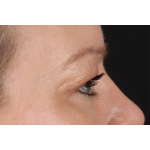 Eyelid Surgery Before & After Patient #2885