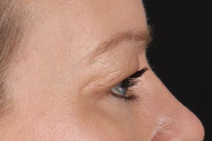 Eyelid Surgery Before & After Patient #2885