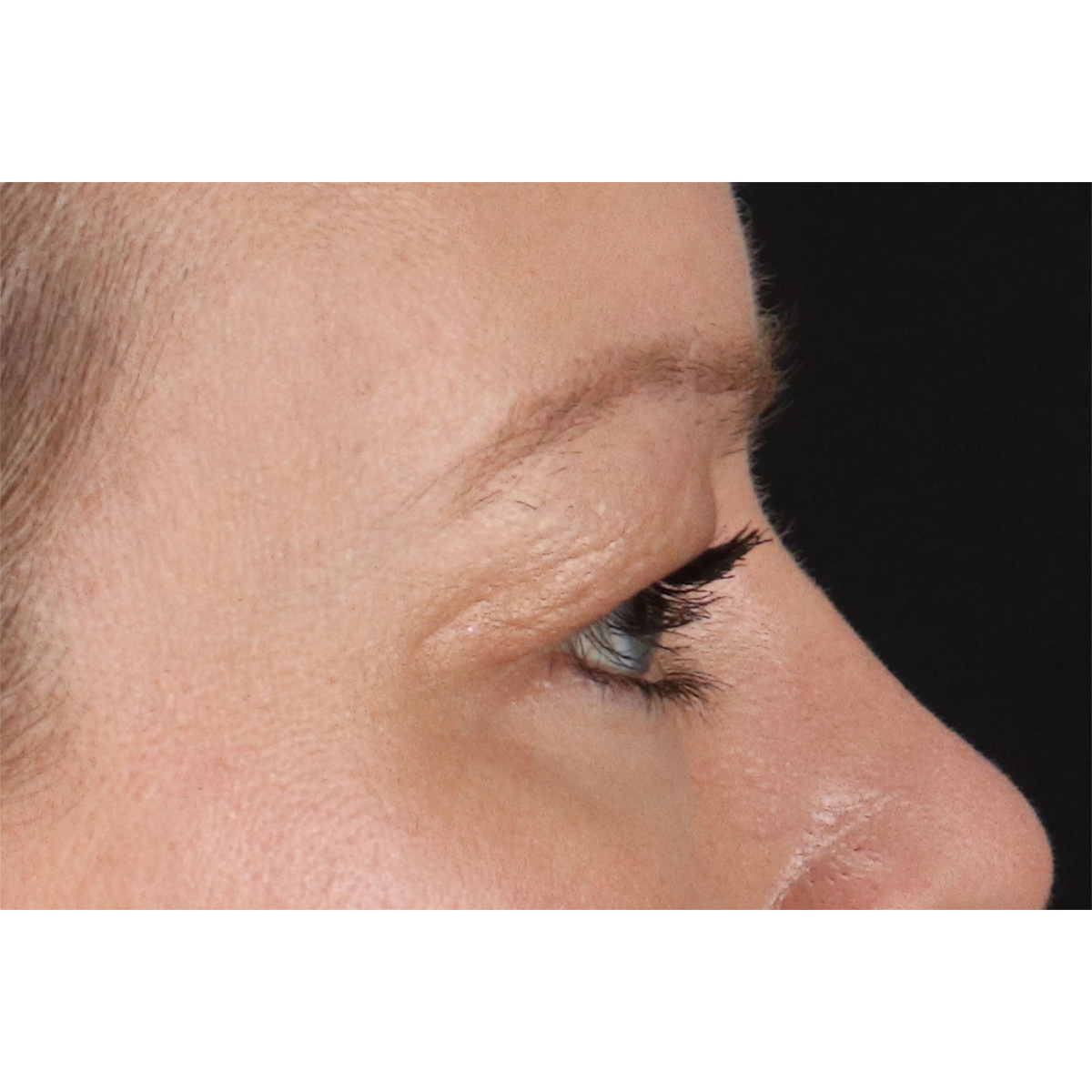 Eyelid Surgery Before & After Patient #2885