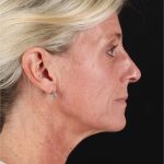 Structural Fat Grafting Before & After Patient #3650