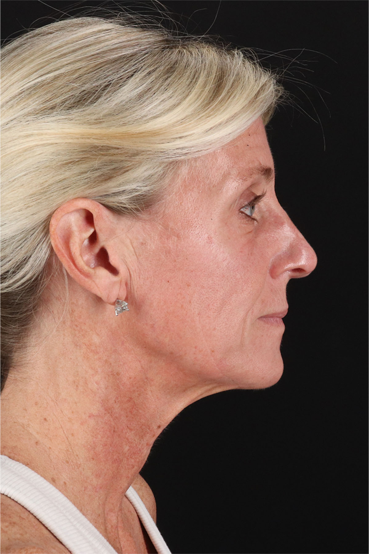 Structural Fat Grafting Before & After Patient #3650