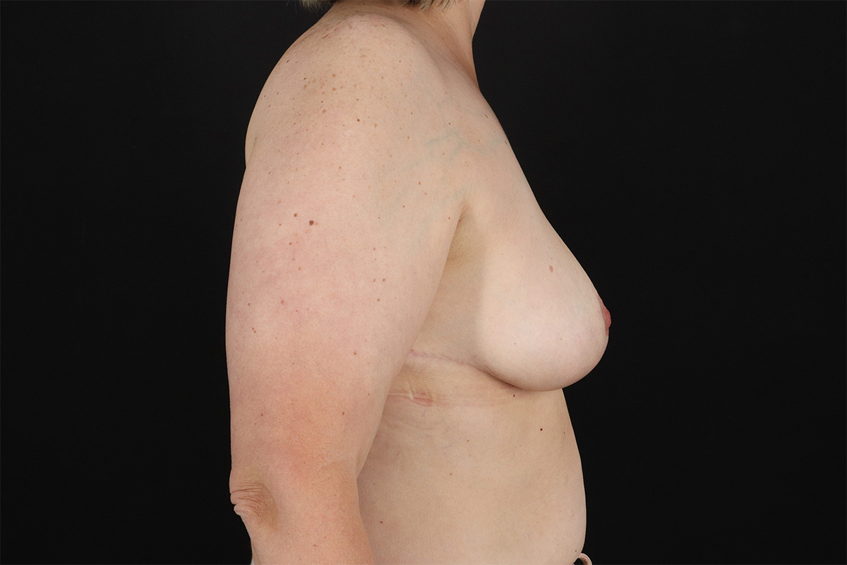 Breast Reduction with Lift Before & After Patient #2877