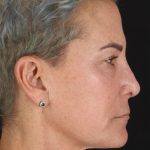 CO2 Laser Before & After Patient #2878