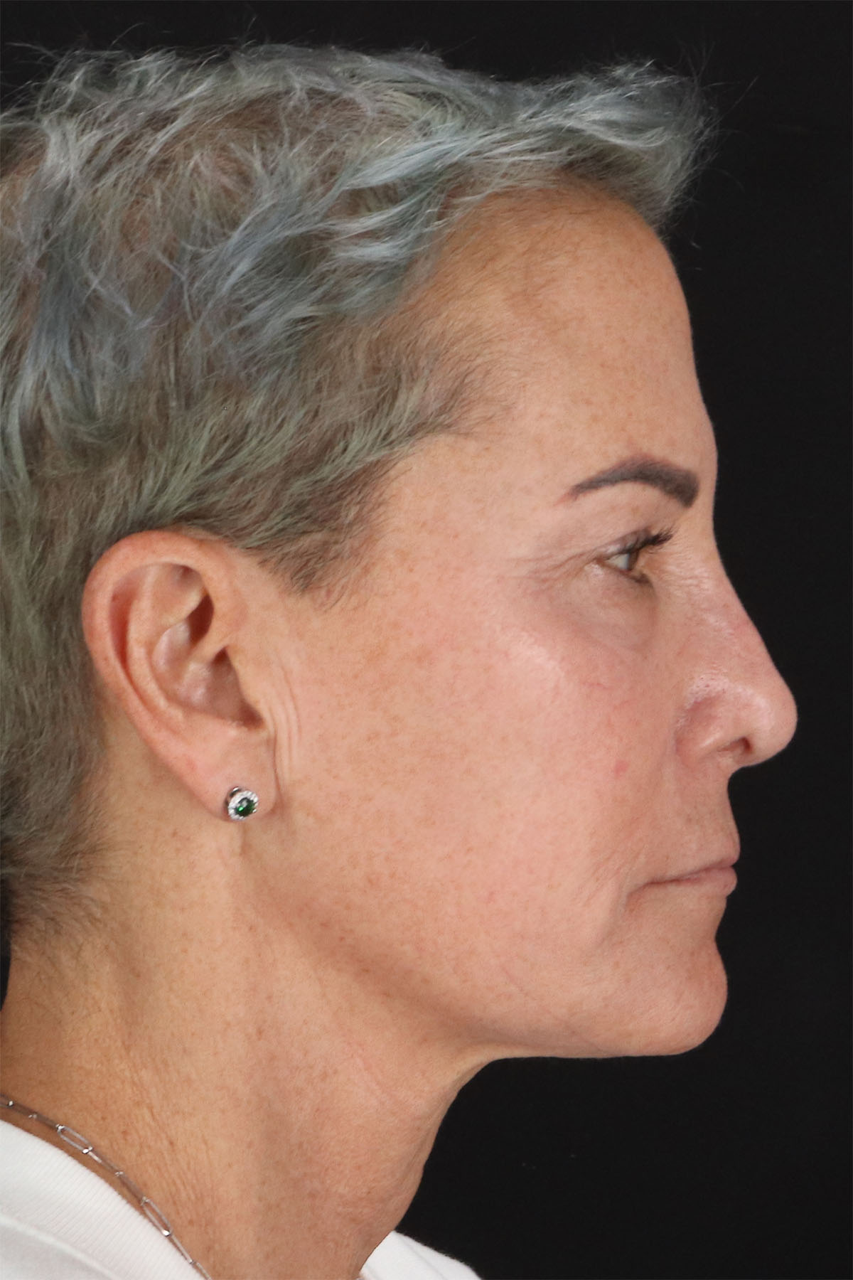 CO2 Laser Before & After Patient #2878