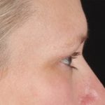 Eyelid Surgery Before & After Patient #2879